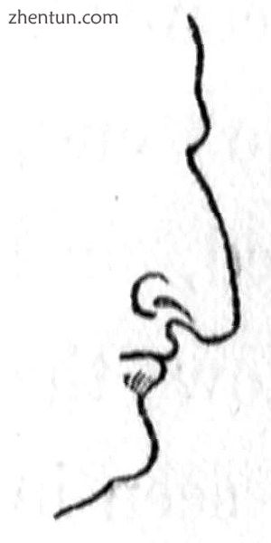 Rhinoplasty Nasal Class IV. The Hawk nose. (Nasology Eden Warwick, 1848).jpg
