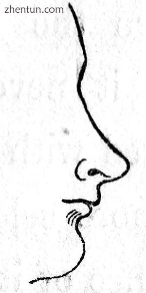 Rhinoplasty Nasal Class VI. The celestial nose. (Nasology Eden Warwick, 1848).jpg