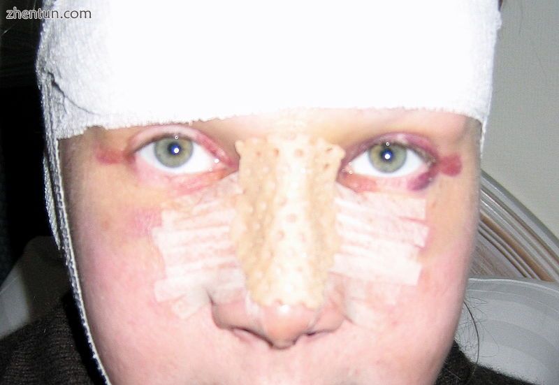 At 3-days post-operative, the patient wearing their nasal splint after a dorsal .jpg
