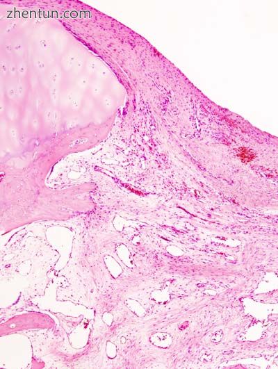 Histopathology of osteoarthrosis of a knee joint in an elderly female..jpg