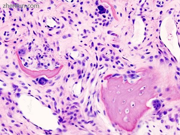 Histopathology of osteoarthrosis of a knee joint in an elderly female.2.jpg