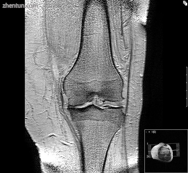 MRI of osteoarthritis in the knee, with characteristic narrowing of the joint space..jpg