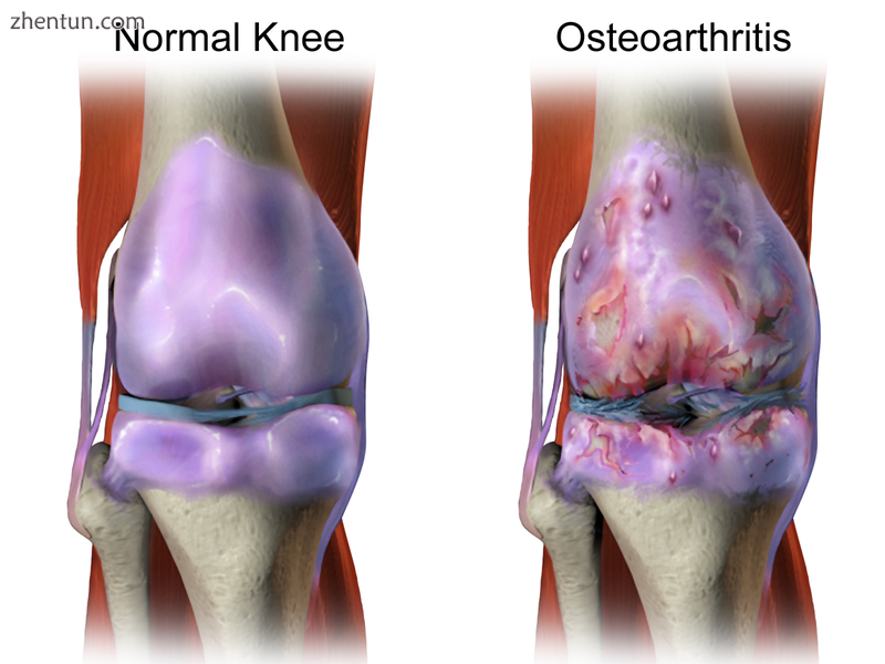 Osteoarthritis.png