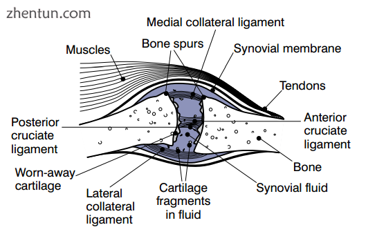With osteoarthritis, the cartilage becomes worn away. Spurs grow out from the ed.png