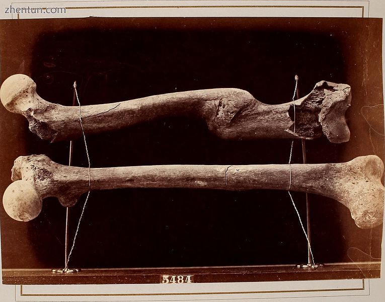 Femur (top) healed while improperly aligned.jpg