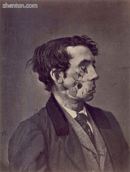 1865 illustration of a private injured in the American Civil War by a shell two .jpg