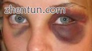 Bruising, a common symptom in facial trauma.jpg