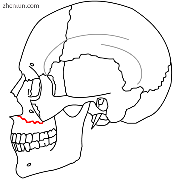 Le Fort I fractures.png