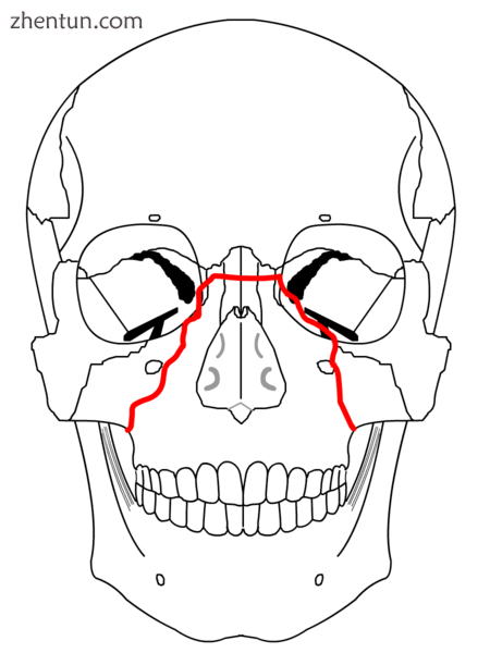 Le Fort II fractures.png