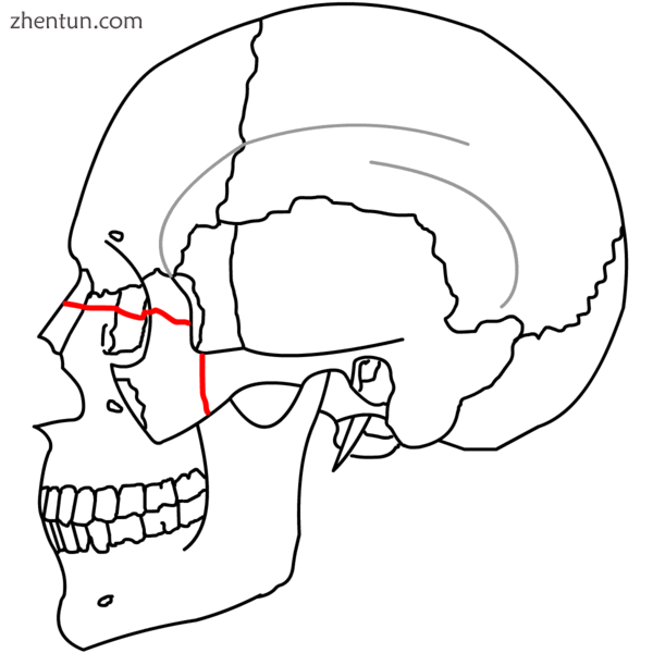 Le Fort III fractures.png