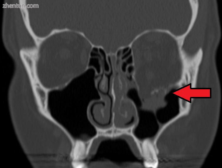 Left orbital floor fracture.png