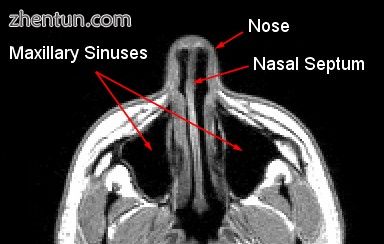 MRI image showing nasal septum..jpg