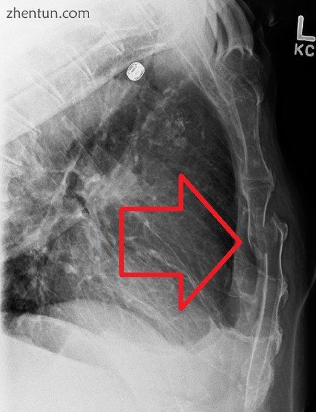 A displaced sternal fracture as seen on plain X-ray.jpg