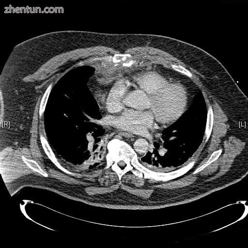CT scan showing a comminuted sternal fracture.[12].jpg