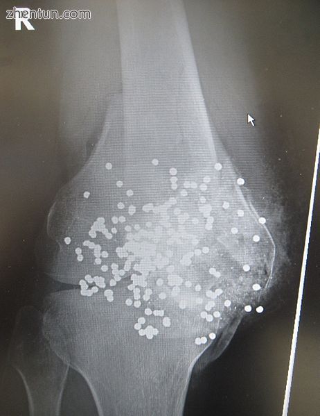 Radiograph of a close-range shotgun blast injury to the knee. Birdshot pellets a.jpg