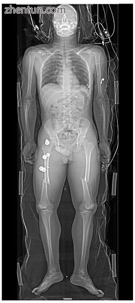 Whole body radiograph of traumatic injuries.jpg