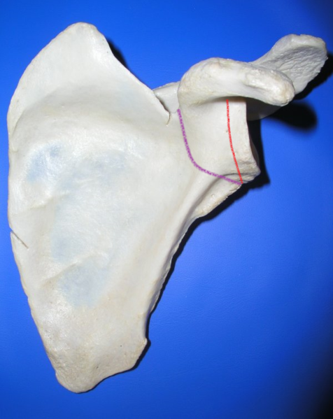 Left scapula, anterior surface. Anatomic neck red, Surgical neck purple.png