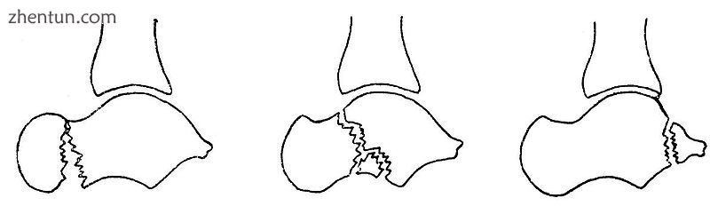 From left to right Fracture of the neck, body and posterior process of the talus..jpg