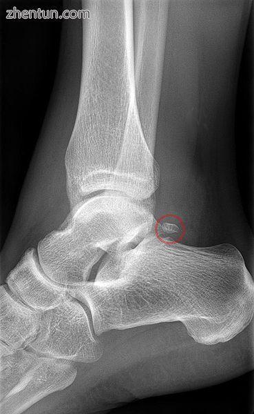 Os trigonum on x-ray..jpg