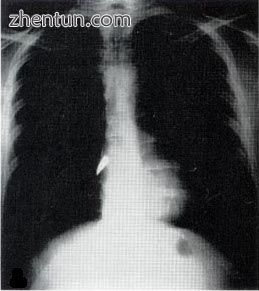X-ray showing a bullet (white spot) in the heart.jpg