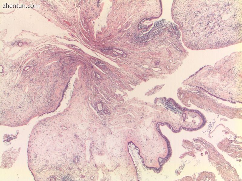 Histology of nasal polyp, magnification 25x (H&amp;E stain).jpg