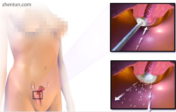 Cervical cryotherapy.jpg
