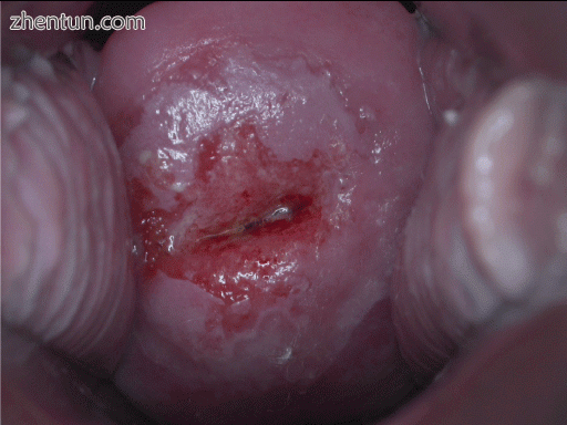 Positive visual inspection with acetic acid of the cervix for CIN-1.gif