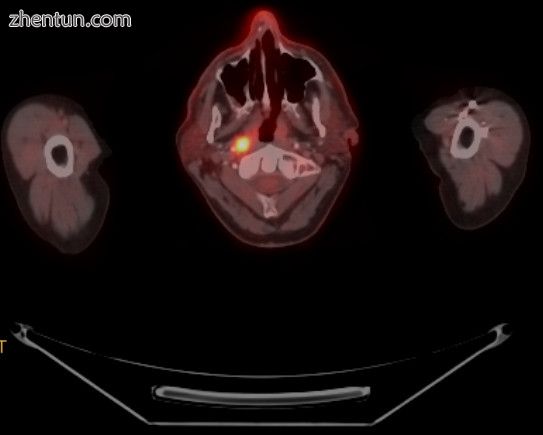 FDG-PET CT scan of a patient with nasopharyngeal cancer. Transverse slice demons.jpg