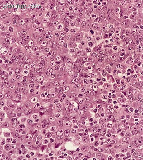 Metastatic nasopharyngeal carcinoma in a lymph node.jpg