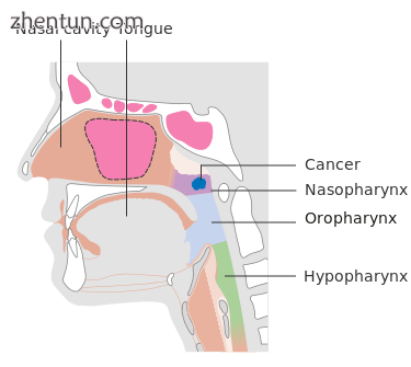 Stage T1 nasopharyngeal cancer.png