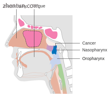 Stage T2 nasopharyngeal cancer.png