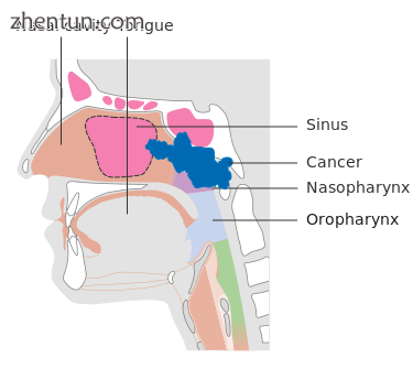 Stage T3 nasopharyngeal cancer.png