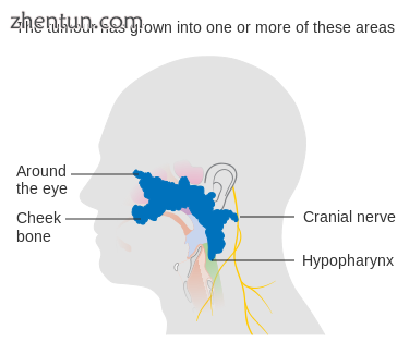 Stage T4 nasopharyngeal cancer.png