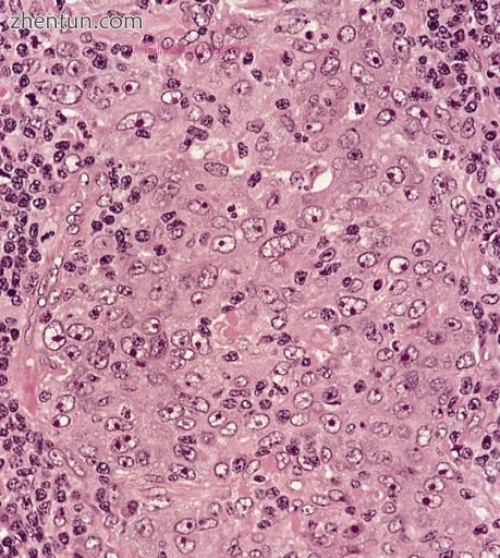 Undifferentiated nasopharyngeal carcinoma—high power.jpg