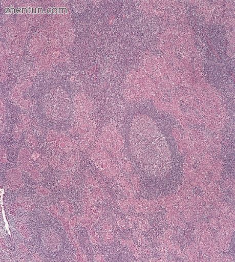 Undifferentiated nasopharyngeal carcinoma—low power.jpg