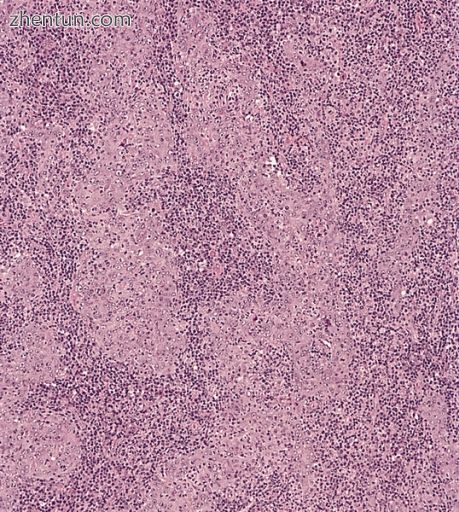 Undifferentiated nasopharyngeal carcinoma—med. power.jpg