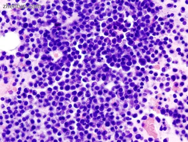 Bone marrow aspirate showing the histologic correlate of multiple myeloma under .jpg