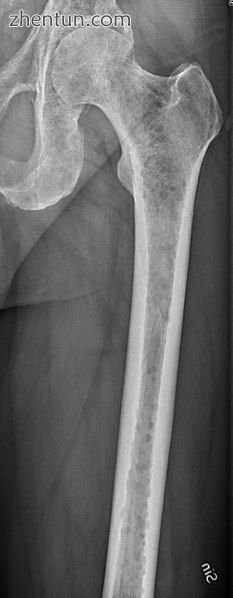 Femur with multiple myeloma lesions..jpg