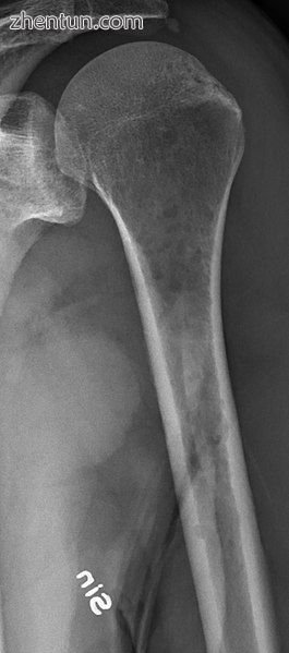 Humerus with multiple myeloma lesions..jpg