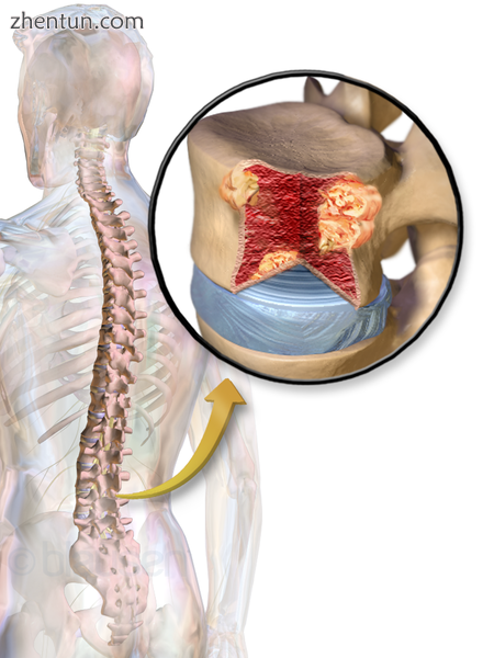 Illustration showing the most common site of bone lesions in vertebrae.png