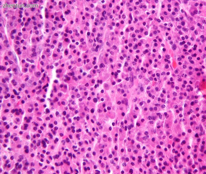 Plasmacytoma. H&amp;E stain..jpg