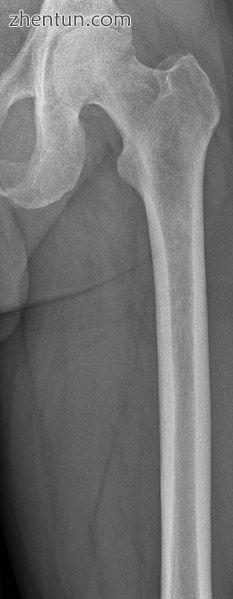 Same femur before myeloma lesions for comparison.jpg