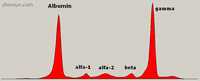 Serum protein electrophoresis showing a paraprotein (peak in the gamma zone) in .png