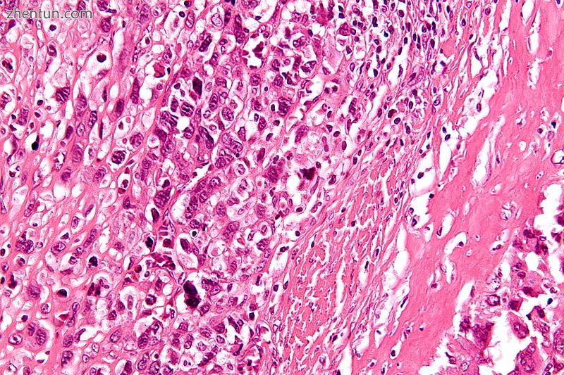 High-magnification micrograph showing osteoid formation in an osteosarcoma H&amp;E.jpg