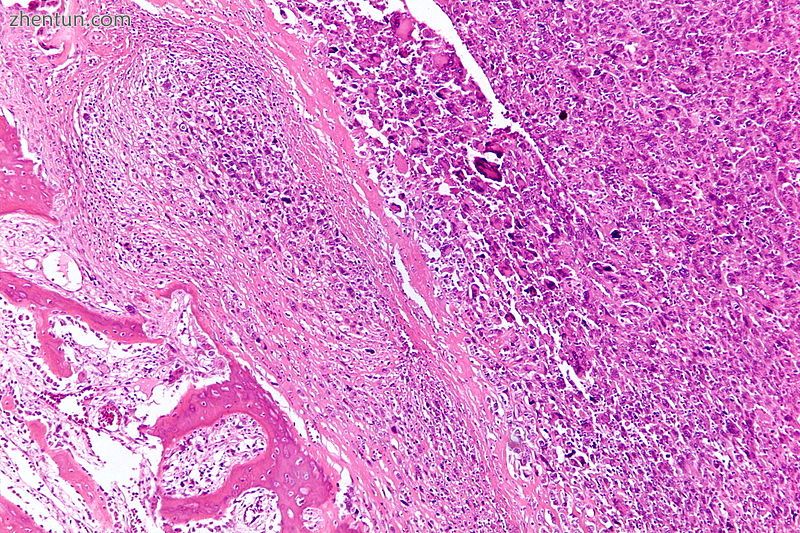 Intermediate-magnification micrograph of an osteosarcoma (c.jpg