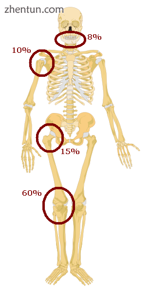 Predilections of osteosarcoma.png