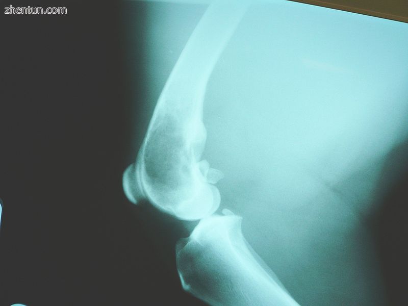 X-ray of osteosarcoma of the distal femur in a dog.JPG