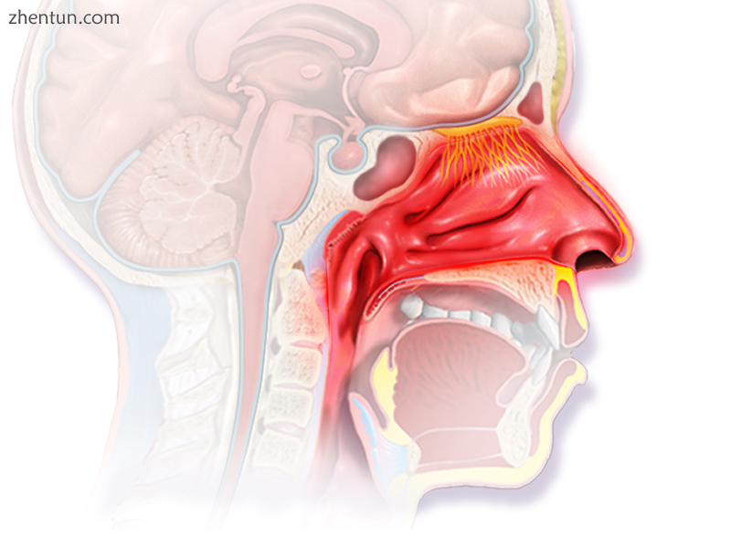 Illustration depicting inflammation associated with allergic rhinitis.png