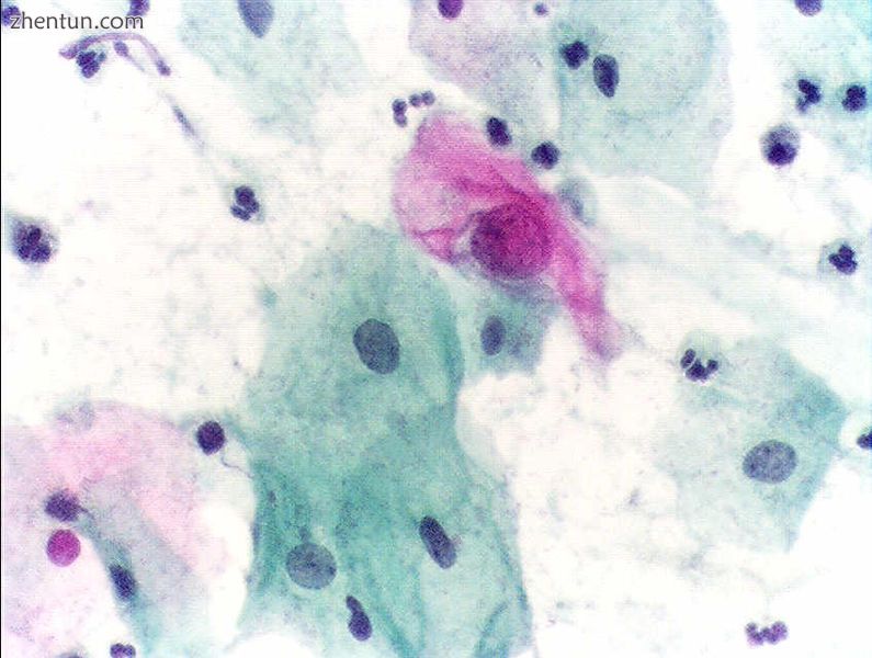 An obviously atypical cell can be seen.JPG