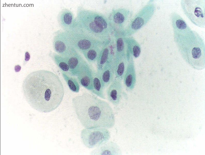 Atrophic squamous cells in postmenopausal women.JPG